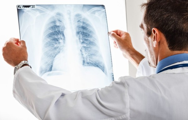 ¿Qué es la fibrosis pulmonar? Síntomas y causas